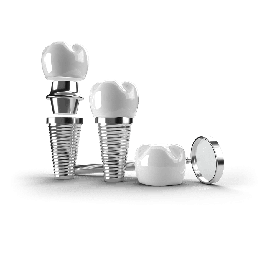 Best Dental Implant Brands in Vietnam 2026: Straumann vs. Nobel Biocare vs. Osstem