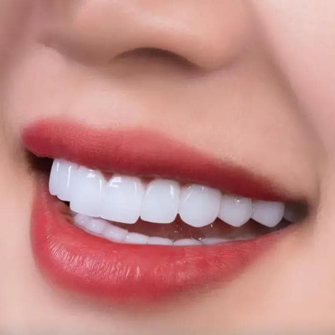 Veneers Cost Comparison: Vietnam vs Australia & USA