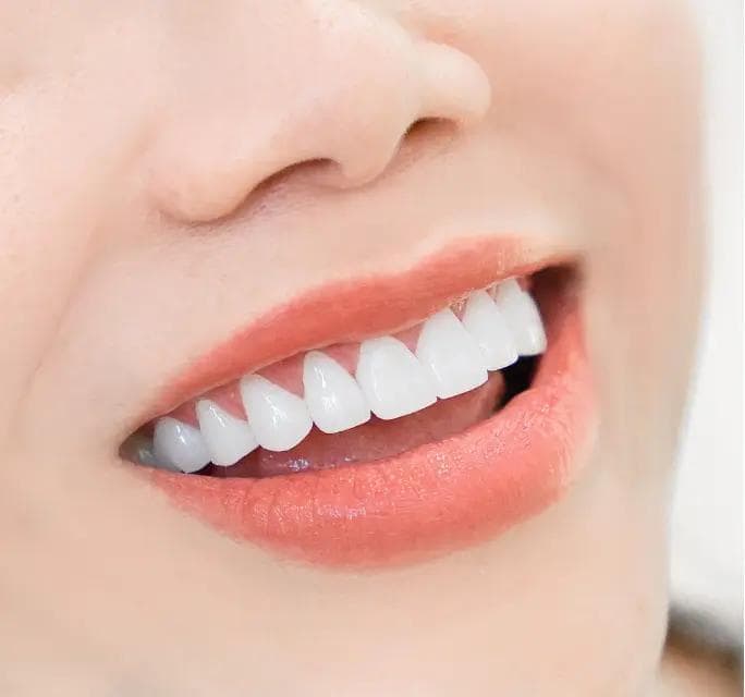 The Complete Guide to Porcelain Veneers in Vietnam: Costs & Safety (2026)